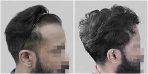 synthetic hair transplant