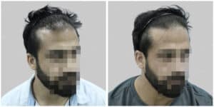 synthetic hair implant