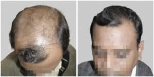 synthetic hair implant