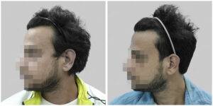 synthetic hair implant