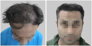 best hair transplant