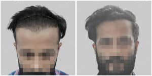 synthetic hair transplant