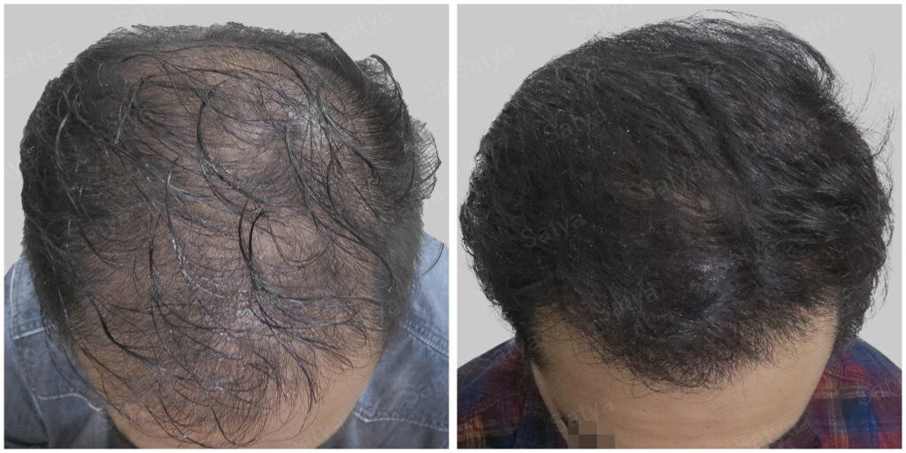 artificial hair transplant