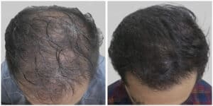artificial hair transplant