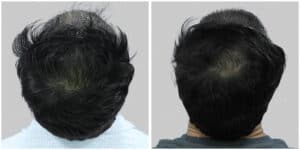synthetic hair implant