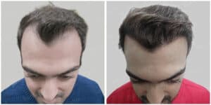fue hair transplant