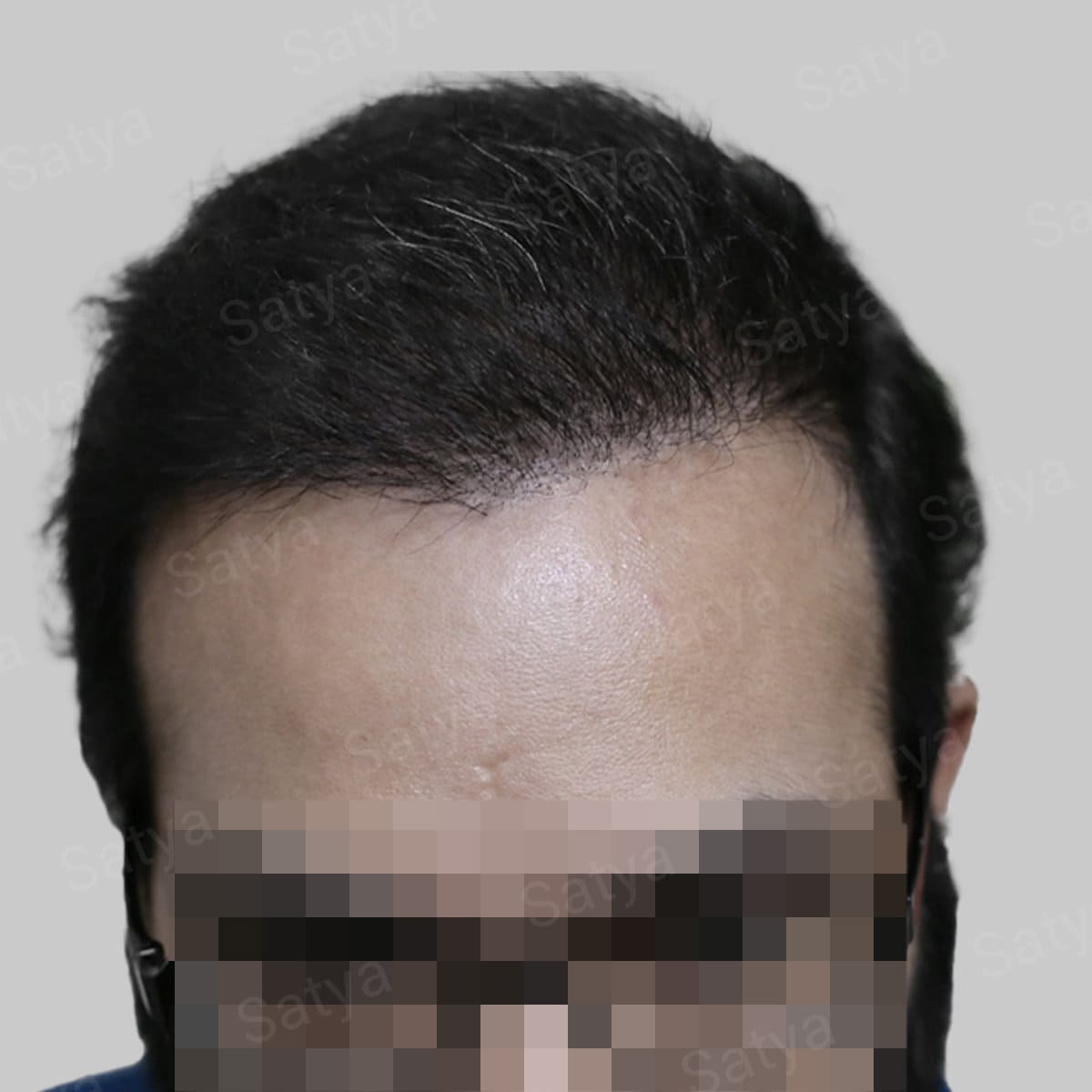 synthetic hair implant