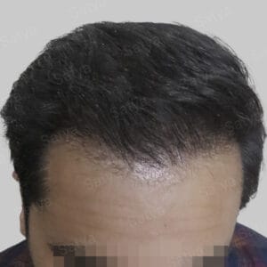 artificial hair implant