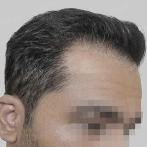 artificial hair transplant