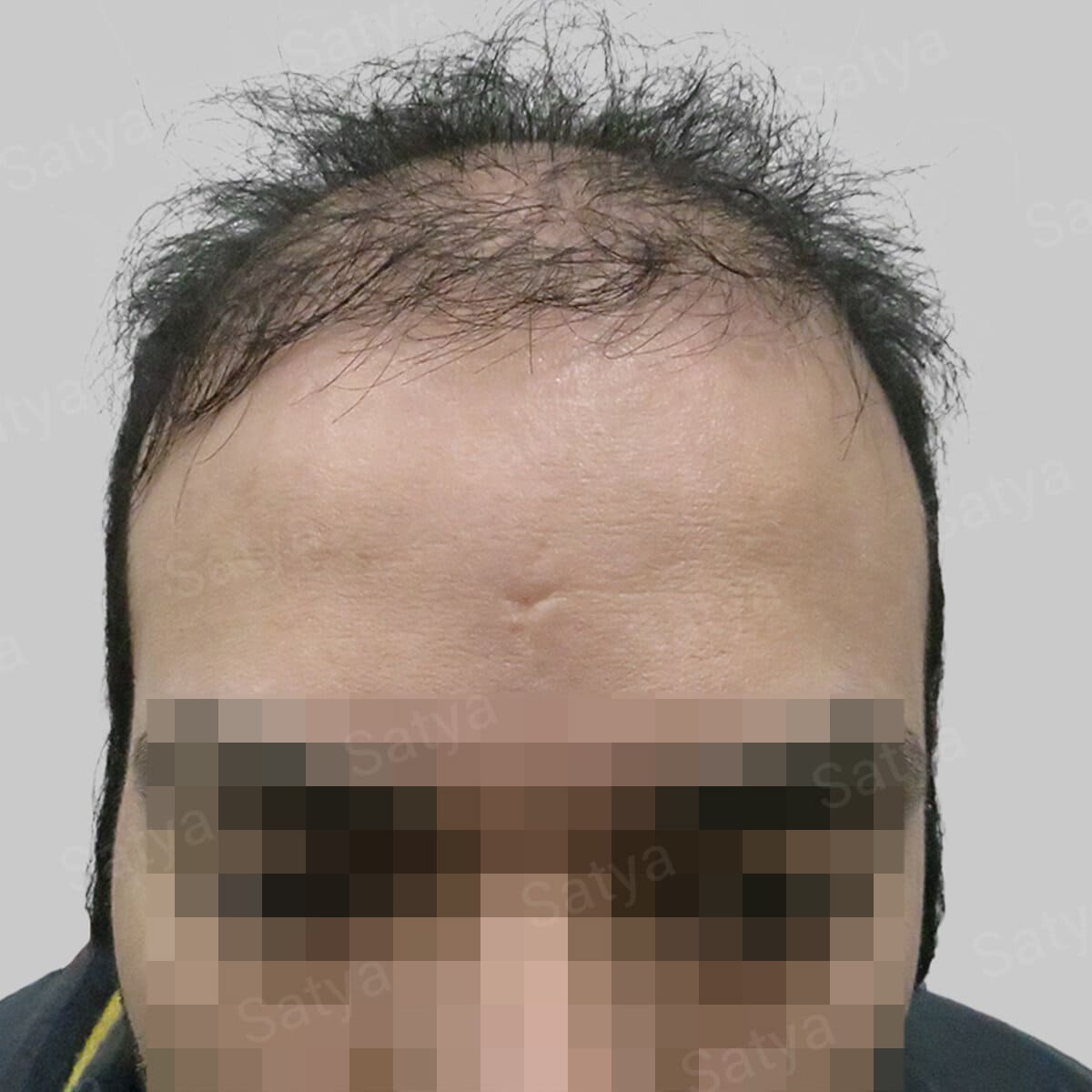 synthetic hair implant