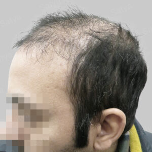 synthetic hair implant