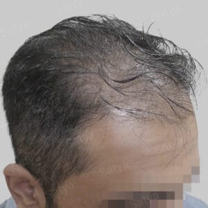 artificial hair transplant