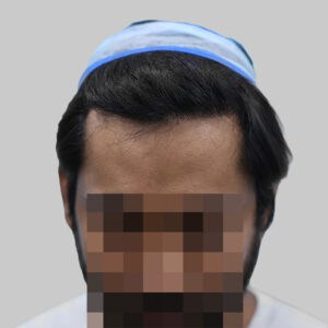 repair hair transplant