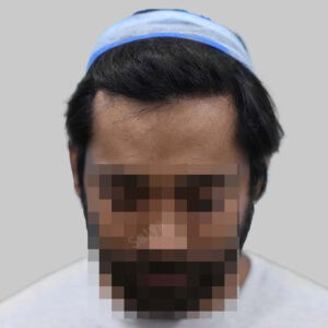 repair hair transplant