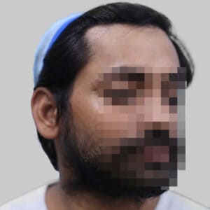 repair hair transplant