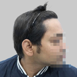 repair hair transplant