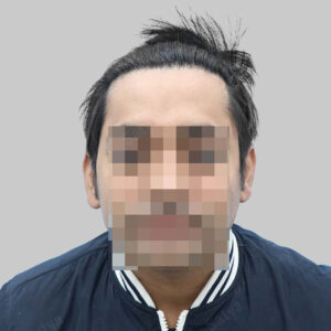 repair hair transplant