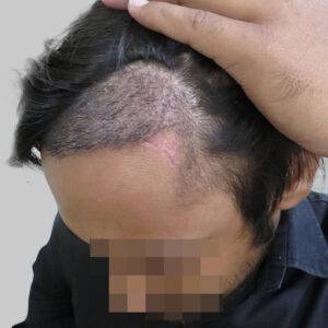 repair hair transplant
