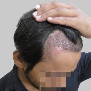 repair hair transplant