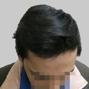 repair hair transplant