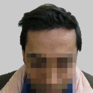 repair hair transplant
