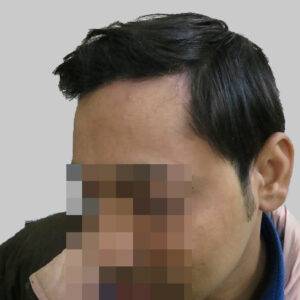 repair hair transplant