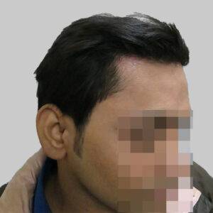 repair hair transplant