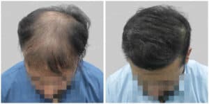 fue hair transplant
