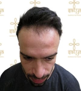 hair restoration
