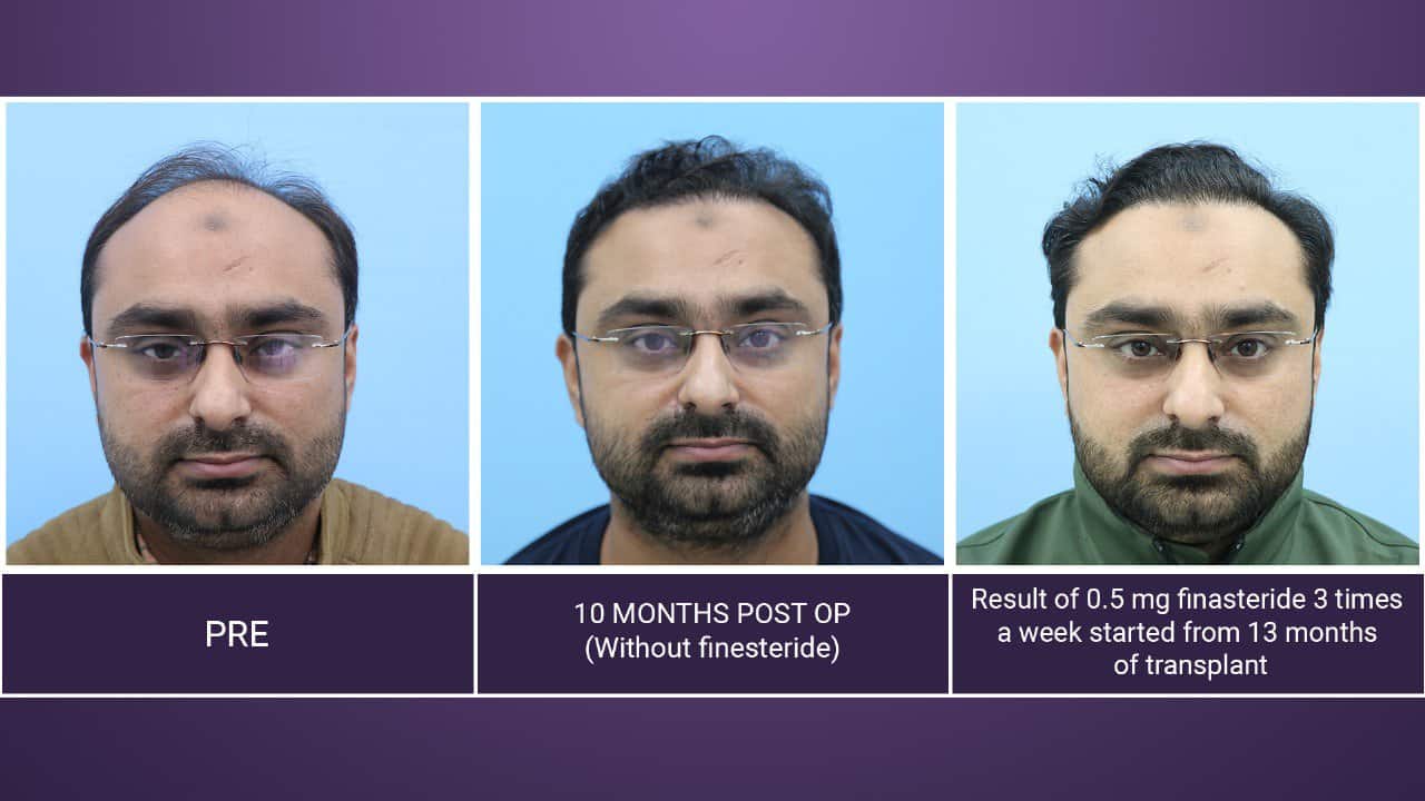 hair restoration