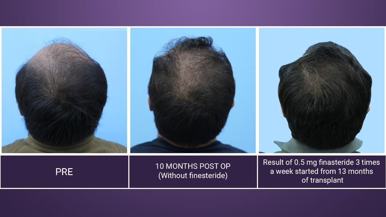 hair restoration