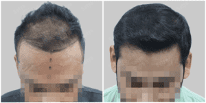 hair transplant in gurgaon