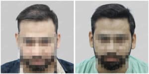 hair transplant in gurgaon