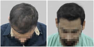 hair transplant in gurgaon