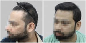 hair transplant in gurgaon