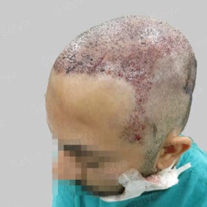 synthetic hair implant