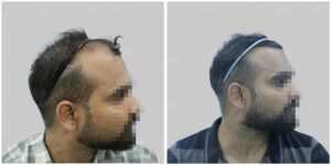 hair transplant in gurgaon