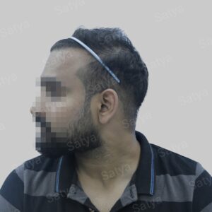 repair hair transplant