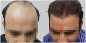 fue hair transplant