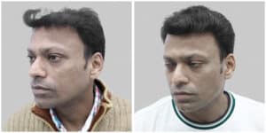 repair hair transplant