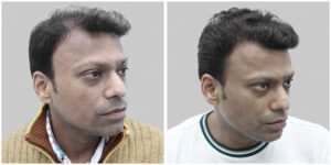 repair hair transplant