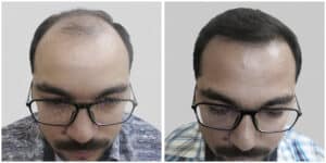 repair hair transplant