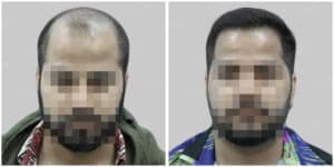 fue hair transplant