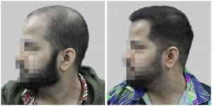 hair restoration