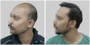 hair transplant in delhi