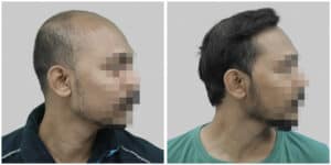 hair transplant in delhi