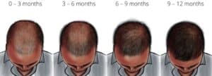 How Long Does Finasteride Take to Work