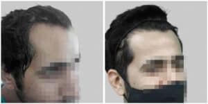 fue hair transplant