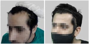 fue hair transplant