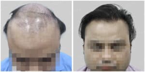 fue hair transplant